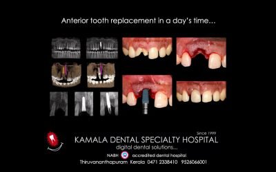 Anterior Tooth Replacement in a day’s time…