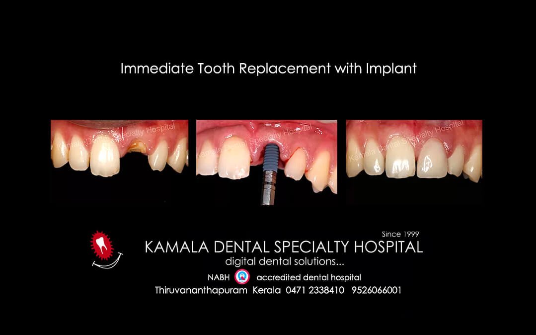 Anterior Tooth Replacement