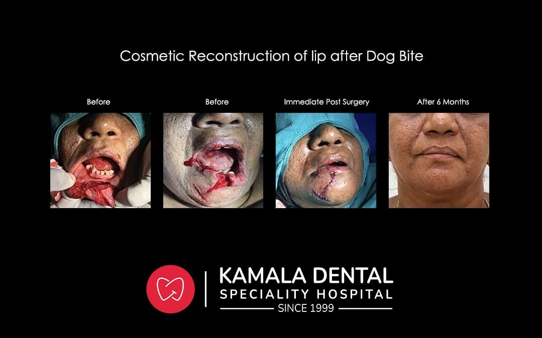Cosmetic Reconstruction of Lip after Dog Bite