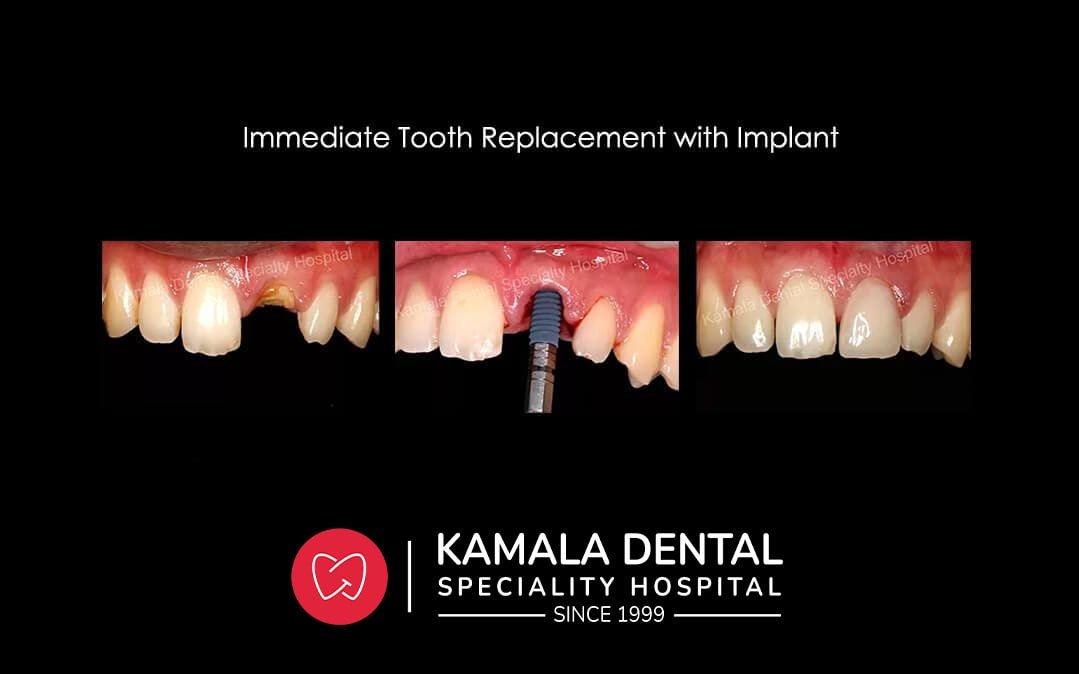 Dental Implants – Best way to get teeth replaced