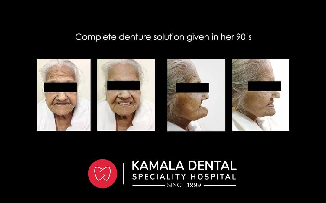 Complete denture solution given in her 90’s