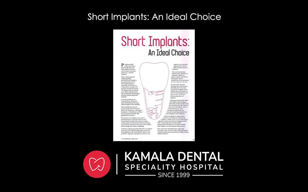 Short Implants: An Ideal Choice