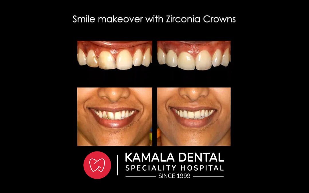 Smile Makeover with Zirconia crowns
