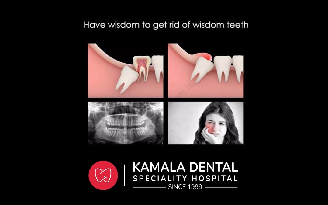 Have Wisdom to get rid of Wisdom Teeth