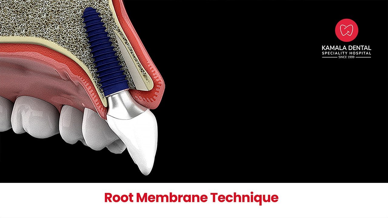 Root Membrane technique from India