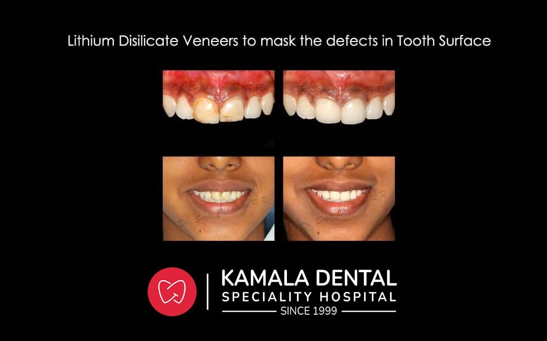 Lithium Disilicate Veneers to mask the defects in tooth surface