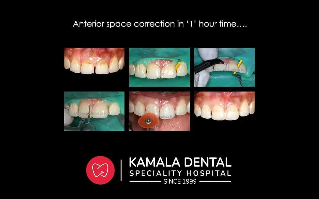 Anterior space correction in ‘1’ hour time….