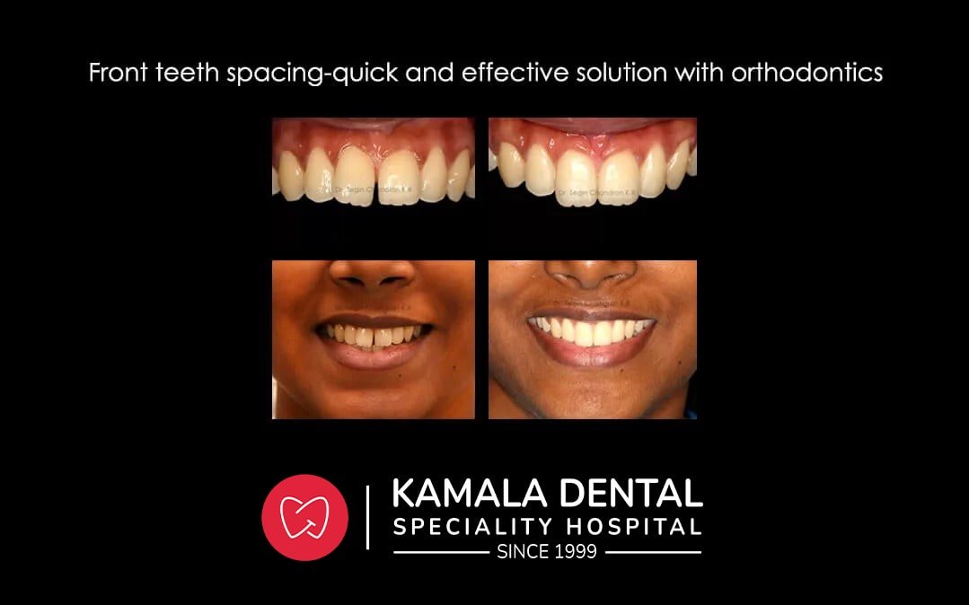 Front teeth spacing-Quick and effective solution with Orthodontics