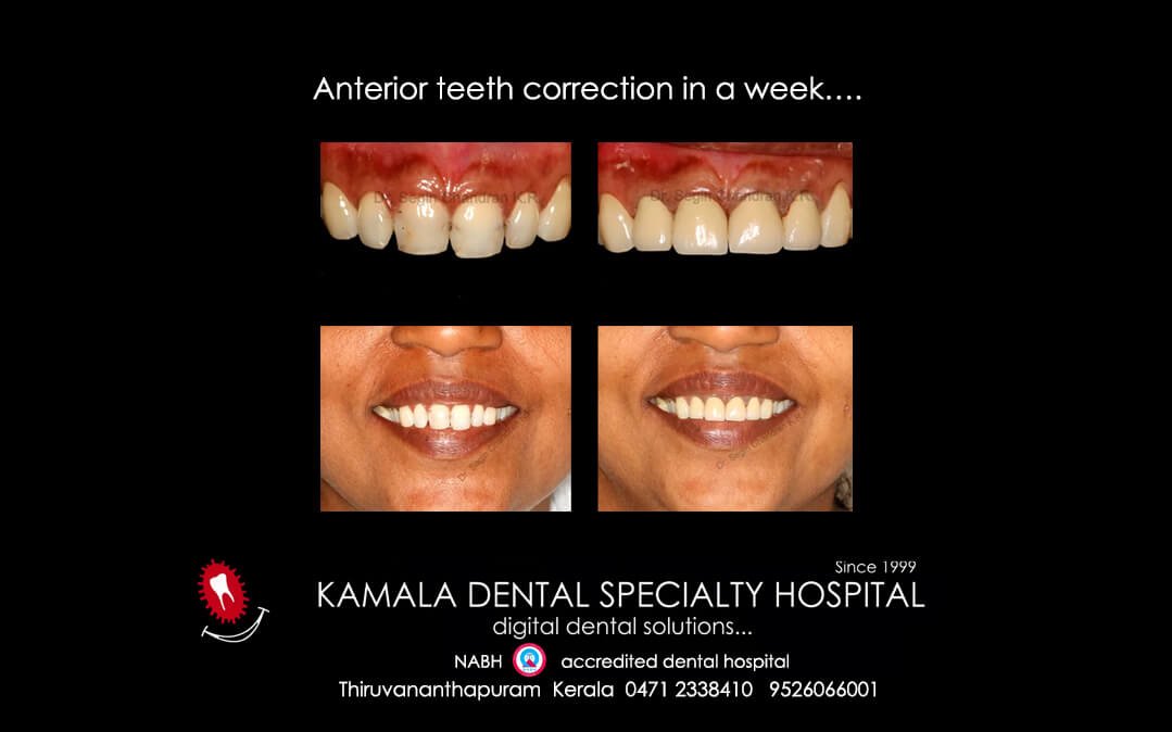 Anterior teeth correction