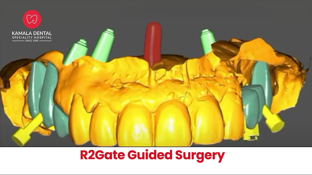 R2Gate Guided Surgery – Dr Segin Chandran and Team, India