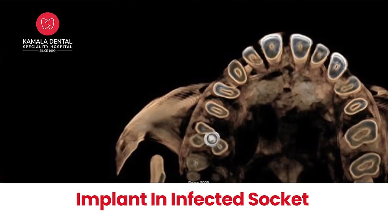 Implant in infected socket