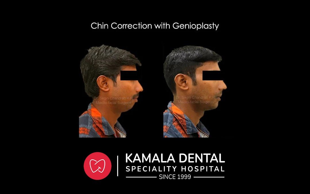 Jaw Correction with Genioplasty