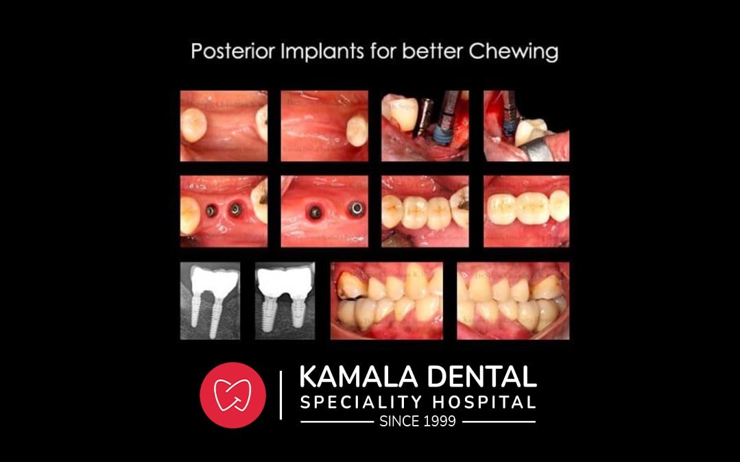 Posterior Implants for better Chewing.