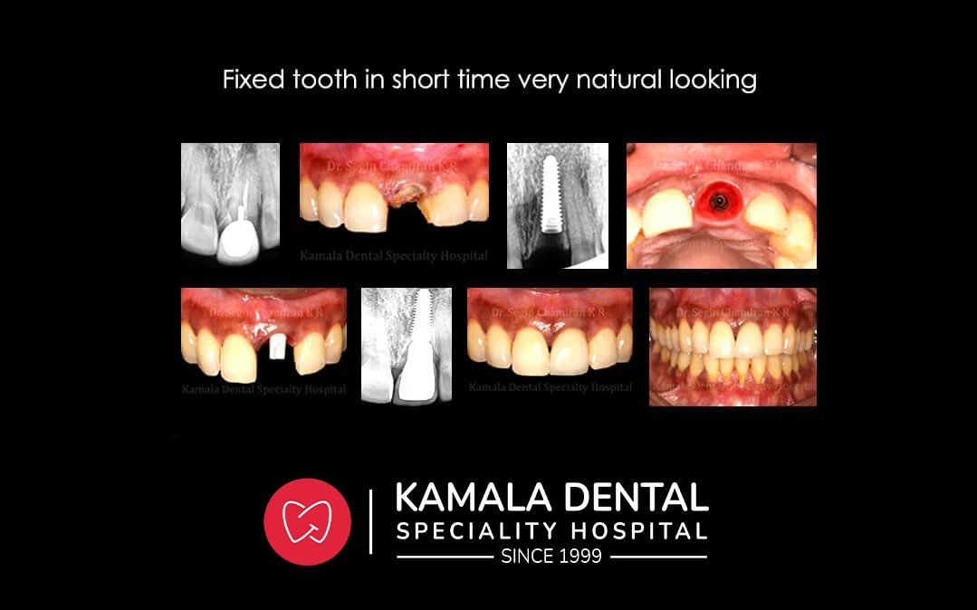 Fixed tooth in short time very natural looking.