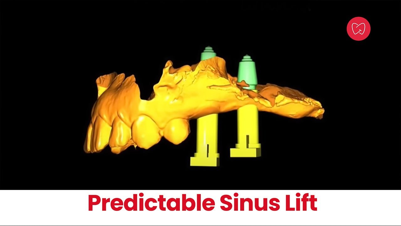 Predictable Sinus Lift – Dr Segin Chandran (India)