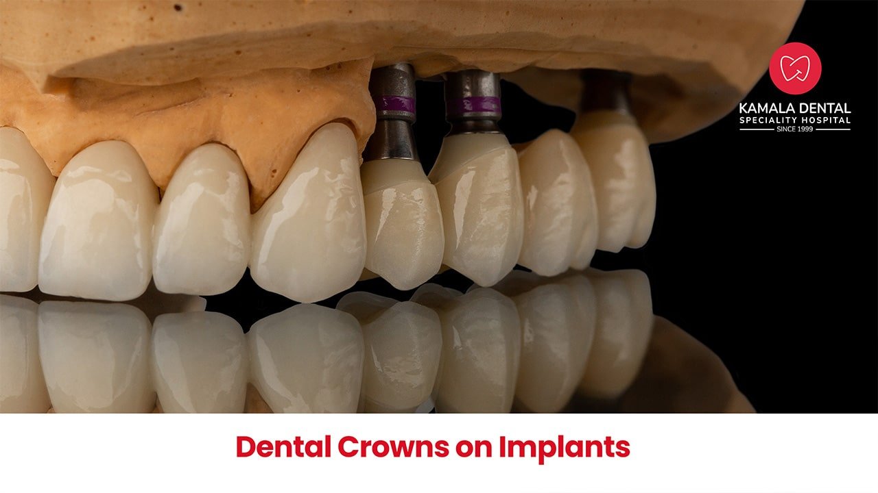 Dental Crowns on Implants