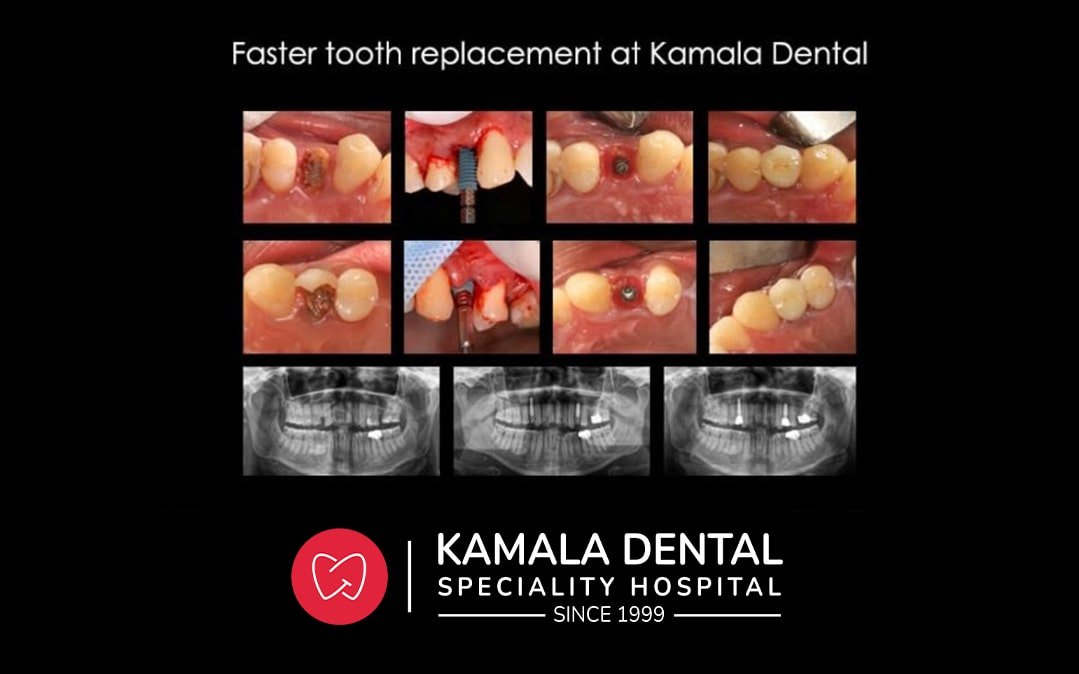 Faster Tooth Replacement At Kamala Dental