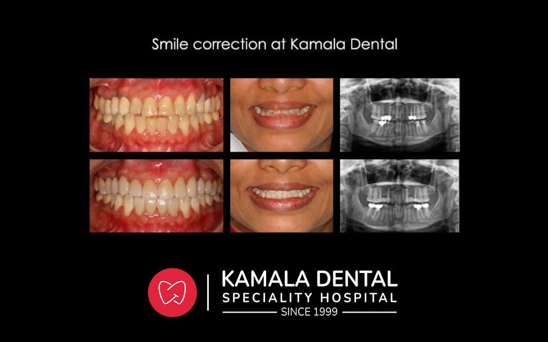 Smile Correction at Kamala Dental Thiruvananthapuram Kerala India