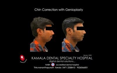 Jaw Correction with Genioplasty