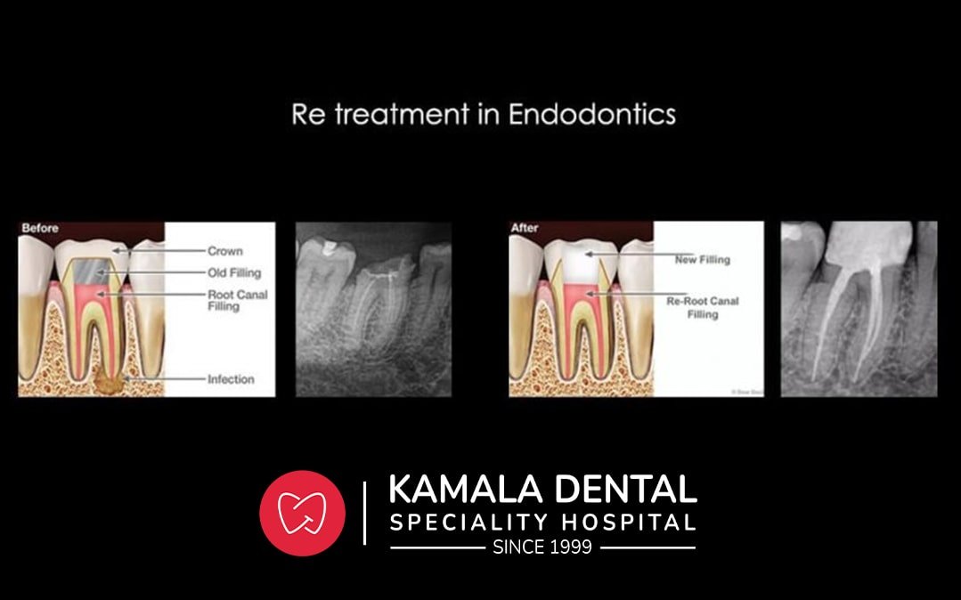 Re treatment in Endodontics – Best in Trivandrum
