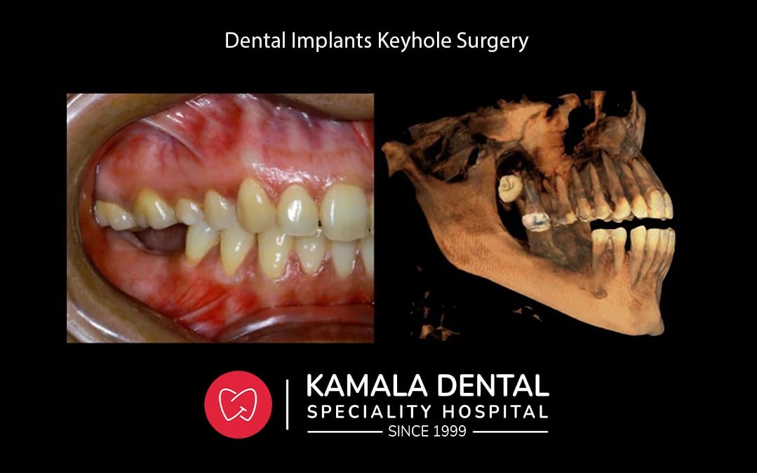 Dental Implants- Keyhole Surgery