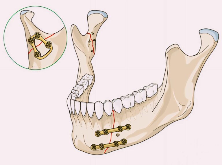 Jaw Fracture - Kamala Dental